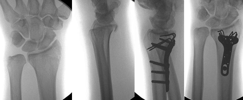 “Pin Under Plate” Technique for Distal Radius Fractures